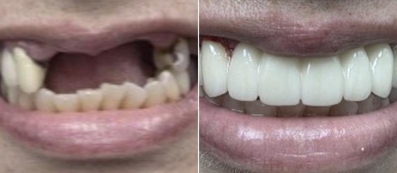 Bridge Before After